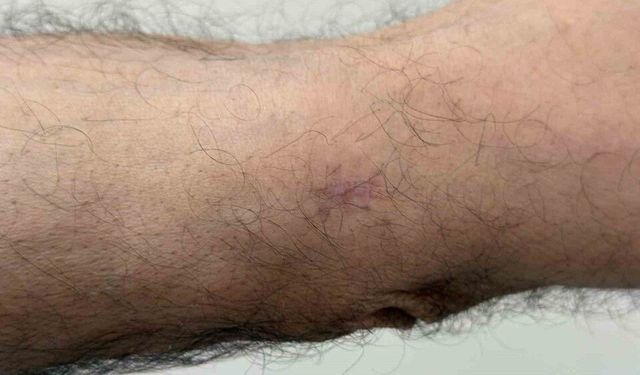 Kolundaki yara için gitti, kanser olduğunu öğrendi